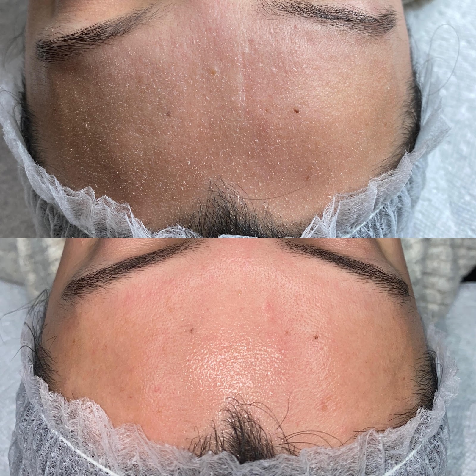 client results for dermaplaning